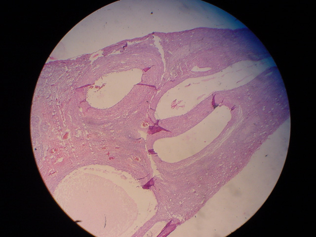 Fig. 6 Caso 2: Ovotestis - <div style=